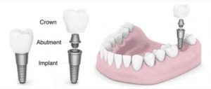 Top Eight Reasons That Dental Implants May Be the Right Choice