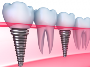 Dental Health: Top reasons that dental implants may be right choice for you, worth your time and money